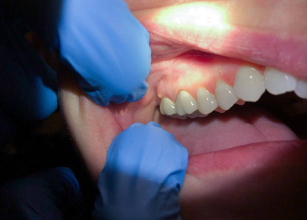 Best Emergency Root Canal Treatment in Centre, AL